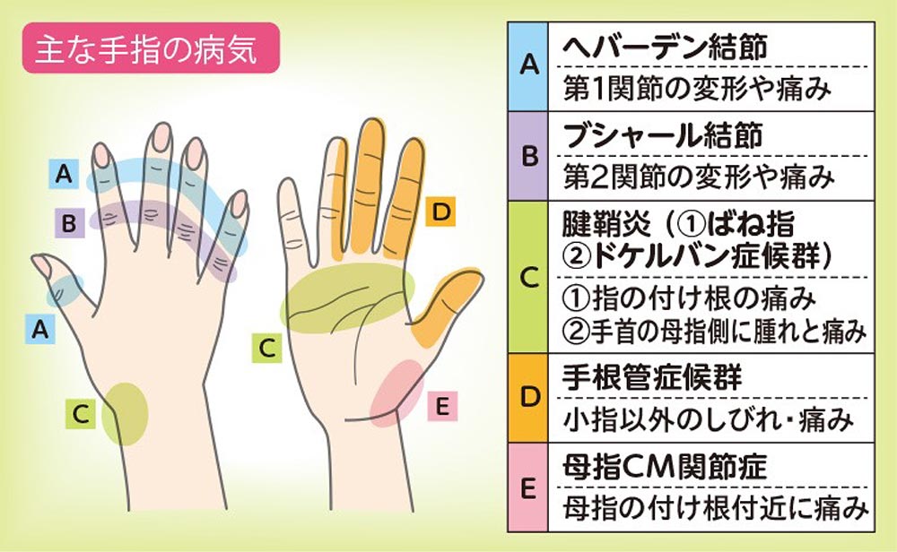 主な手指の病気　A「へバーデン結節」第一関節の変形や痛み　B「ブシャール結節」第二関節の変形や痛み　